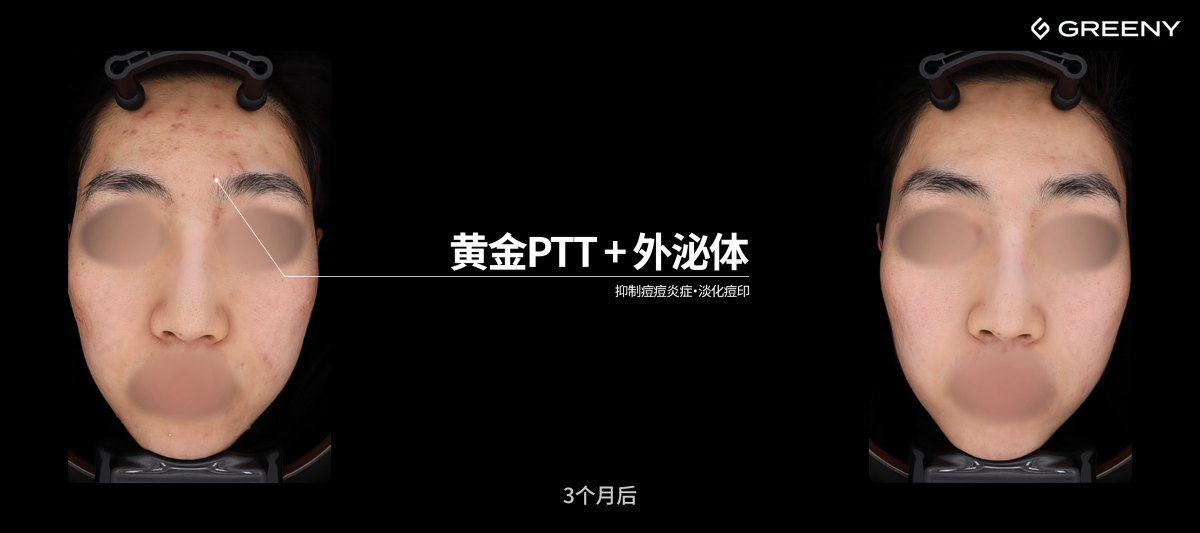 グリーニ皮膚科 — ゴールドPTT + エクソソーム