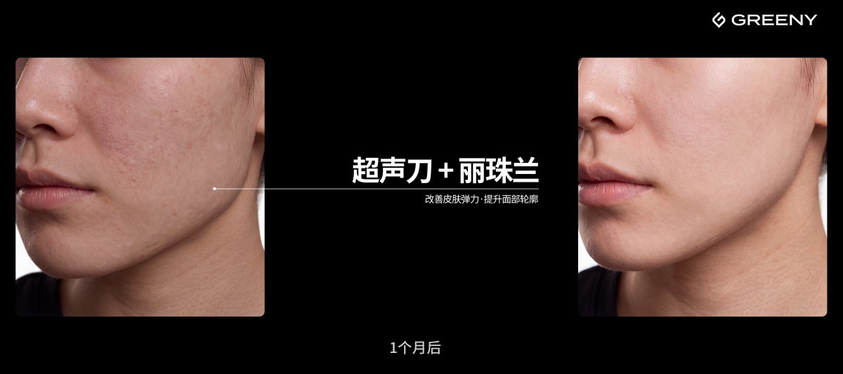 グリーニ皮膚科 — 超音波リフティング + リジュラン